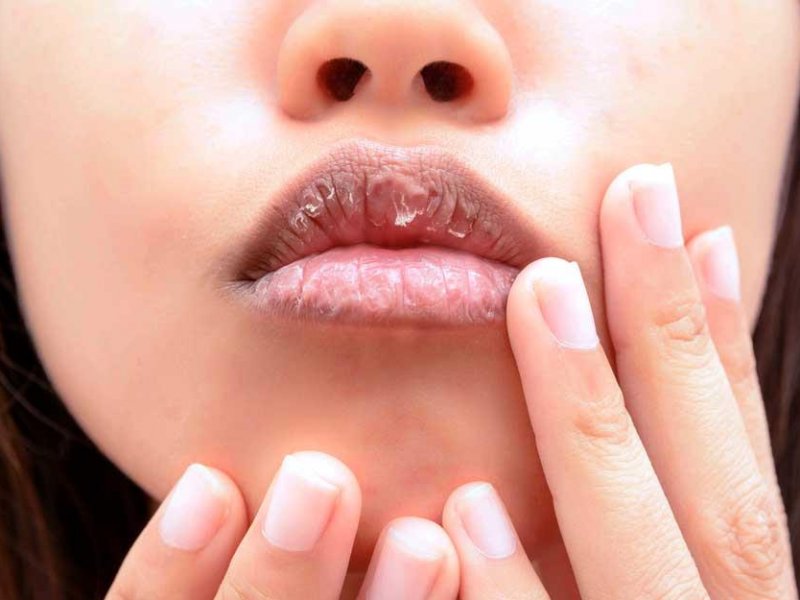 Какво да направите, ако устните изсъхнат: 5 полезни съвета